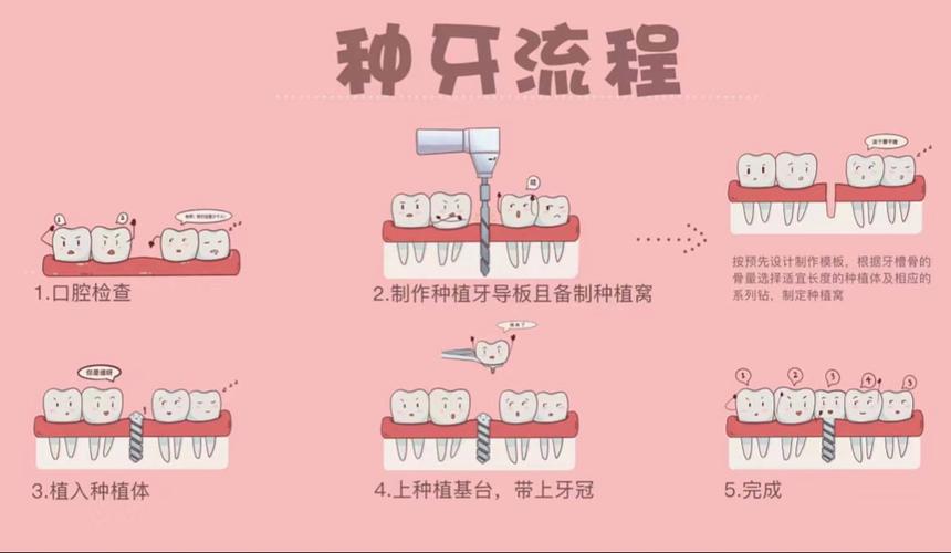 种植牙治疗一般需要复诊几次才能完成?-图2 种植牙治疗一般需要复诊几次才能完成?-图2