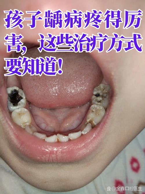 儿童蛀牙有哪些治疗方法？不同情况如何选？-图3