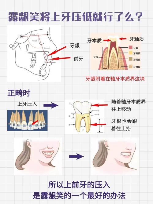 牙周病患者如何选择合适的正畸治疗方法?-图3 牙周病患者如何选择合适的正畸治疗方法?-图3
