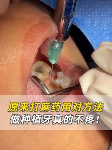 种牙打的麻药是什么?有哪几种常用类型?-图1 种牙打的麻药是什么?有哪几种常用类型?-图1