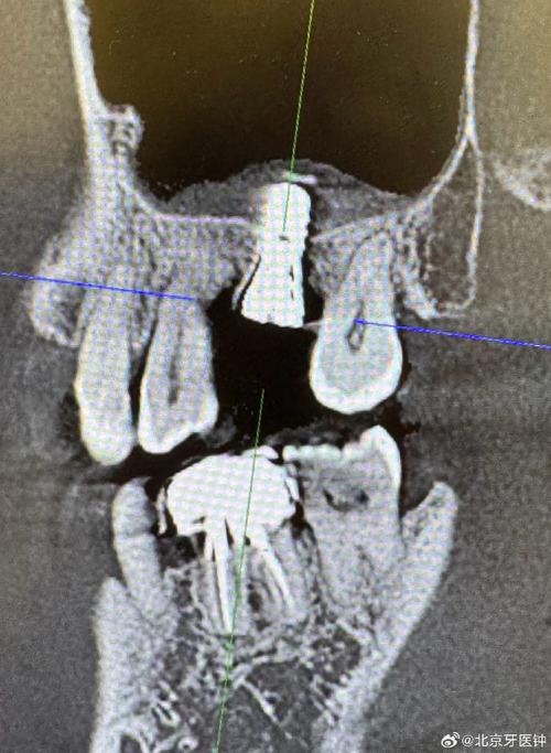 上颌窦提升在种植牙手术中到底起什么关键作用？-图1