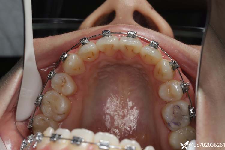 温州口腔附属医院正畸效果如何?需要多长时间矫正?-图3 温州口腔附属医院正畸效果如何?需要多长时间矫正?-图3