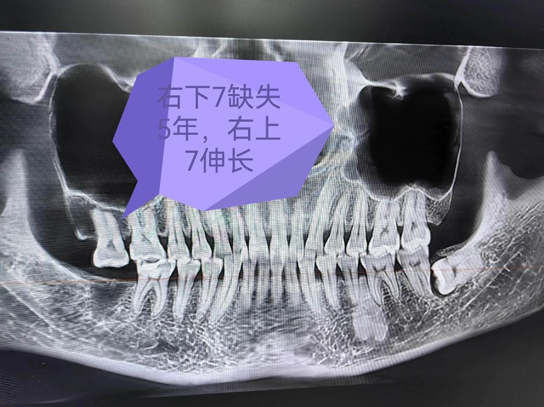 压低下前牙的有效方法有哪些?如何正确操作?-图3 压低下前牙的有效方法有哪些?如何正确操作?-图3