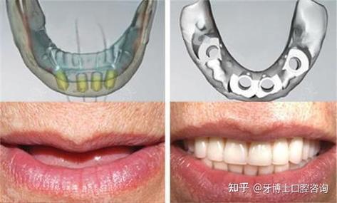 种植牙后多久能正常用牙咀嚼？-图1