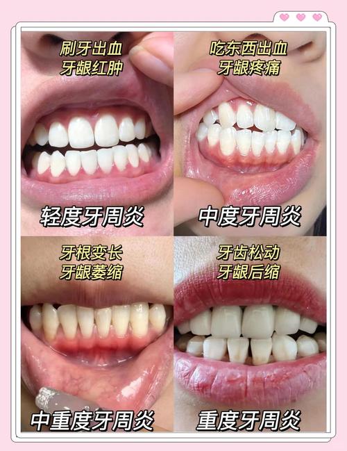 种牙后是否真的会诱发牙周炎？这些风险要了解-图3