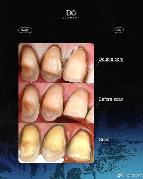 排龈线使用方法有哪些关键步骤？-图2
