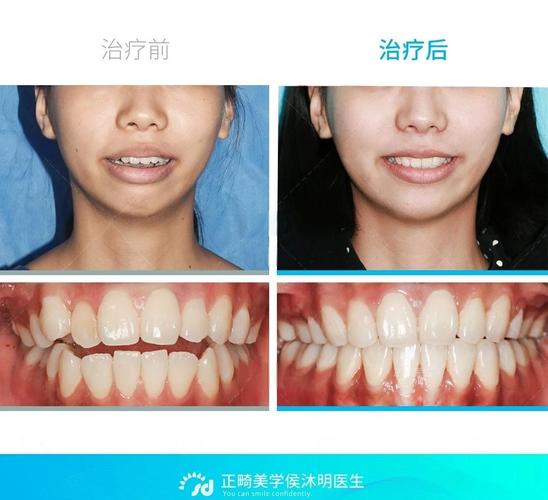 多学科联合如何破解成人正畸复杂难题？-图2