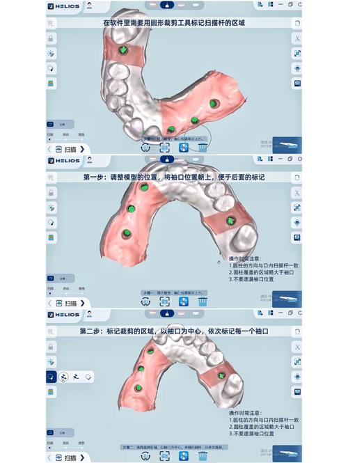 种牙是否必须做CGF？有何作用？-图3