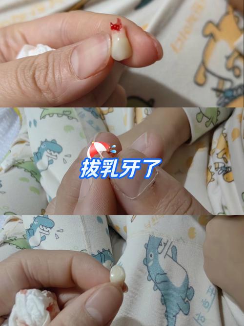 拔乳牙的正确方法是什么？怎么拔才不会伤到？-图1