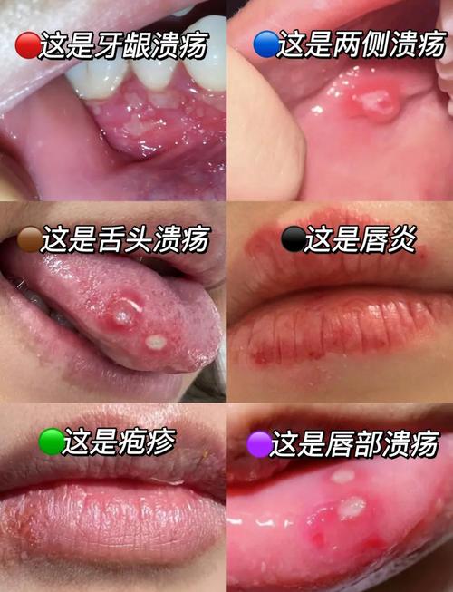 口腔炎有哪些有效的治疗方法及适用情况？-图1