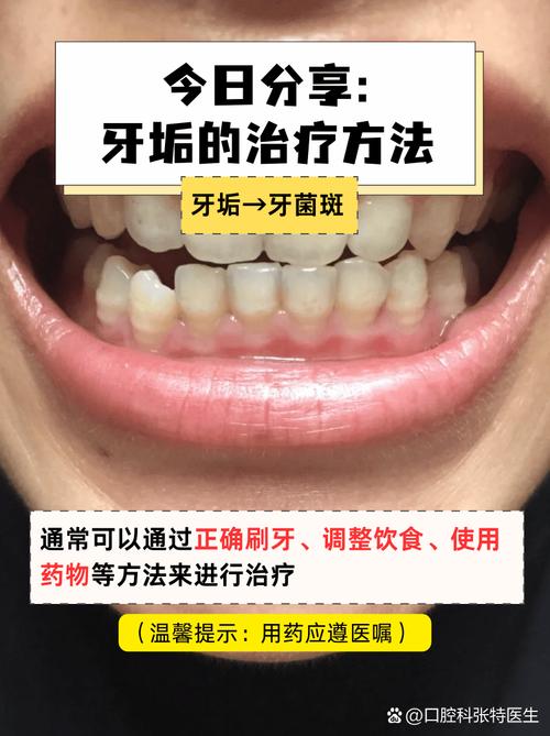 去除牙菌斑的方法-图3 去除牙菌斑的方法-图3