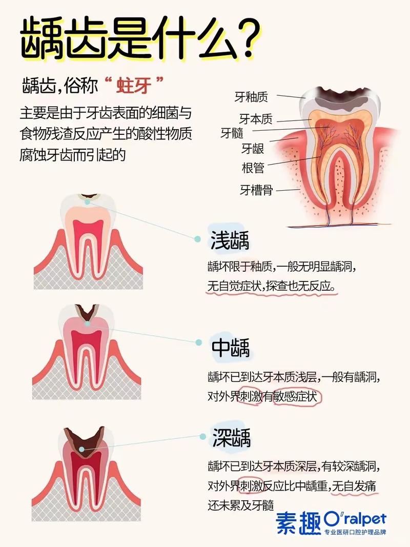儿童龋齿治疗有哪些方法？不同龋坏程度如何选？-图1