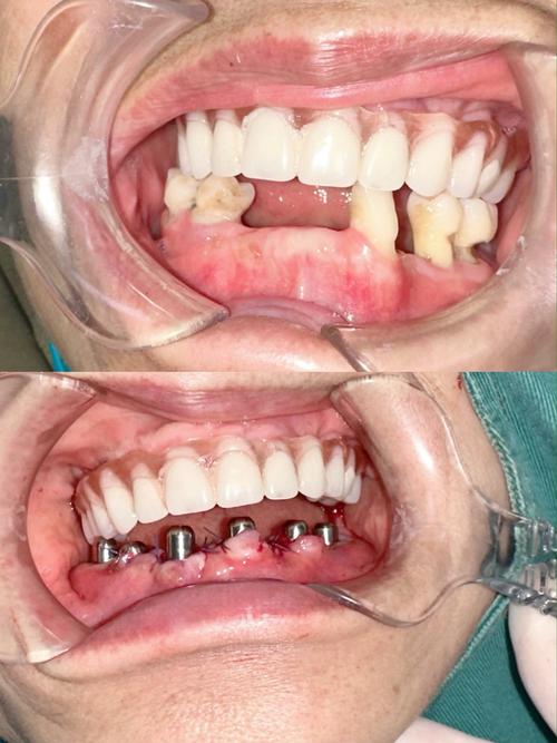 iti种植牙的图片能展示哪些种植体的具体效果？-图1