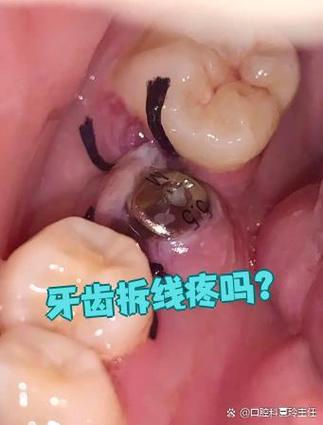 种植牙手术后拆线的时间一般需要等多久合适？-图3