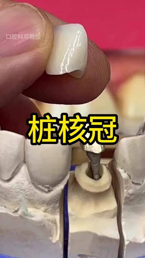 桩核冠粘接方法如何选择？关键步骤有哪些？-图1