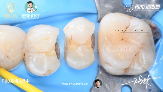 冷牙胶充填方法的关键步骤和注意事项是什么？-图1