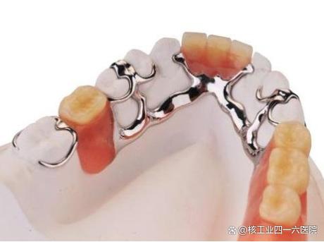 活动义齿为何要改种牙？优势在哪里？-图1