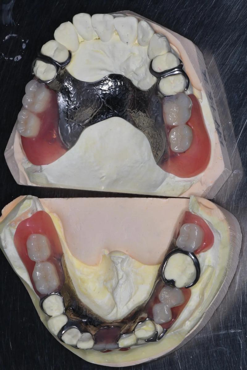活动义齿为何要改种牙？优势在哪里？-图2