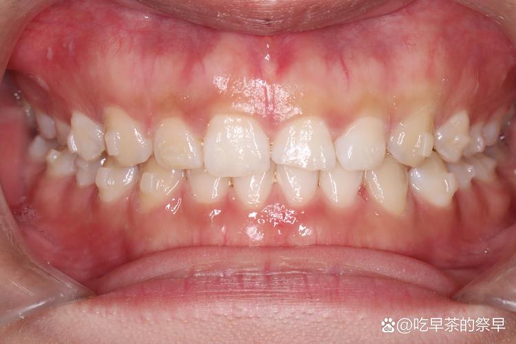 正畸关闭间隙矫正实例，如何高效实现？-图3