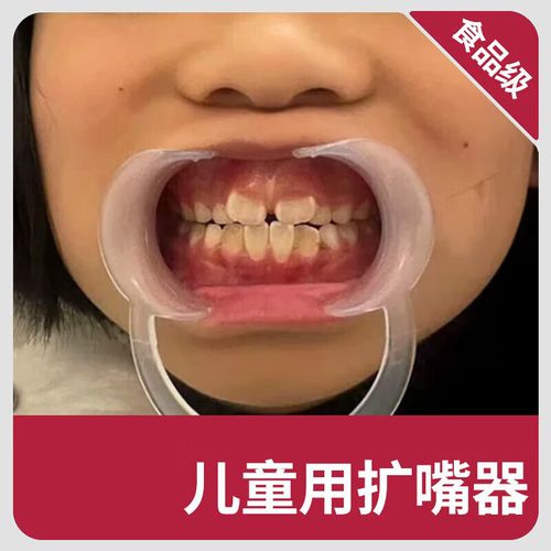 扩牙器如何正确使用?详细步骤与注意事项有哪些?-图1 扩牙器如何正确使用?详细步骤与注意事项有哪些?-图1