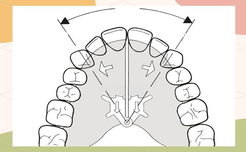 正畸扩牙弓调整磨牙能改善哪些咬合问题？-图3