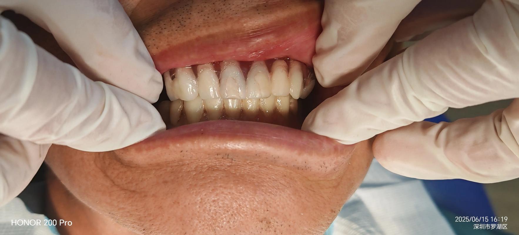 印牙模咬蜡方法的具体操作步骤有哪些？-图1