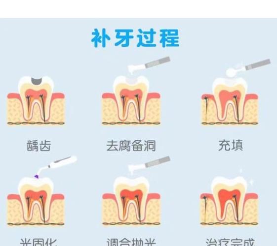 三类洞补牙方法如何选？不同洞型哪种补法更优？-图2