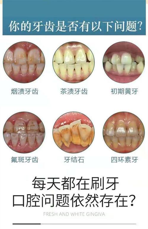 如何有效去除牙齿烟渍？实用方法有哪些？-图3