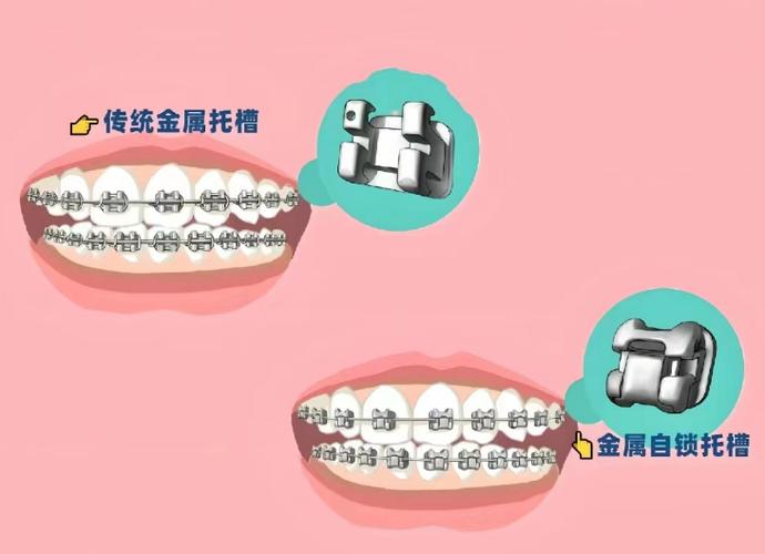 正畸托槽怎么区别左右-图3