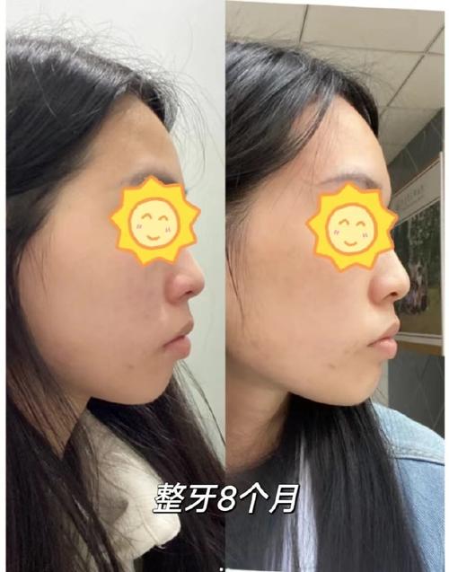 长沙美莱牙齿正畸效果好不好?值得信赖吗?-图1 长沙美莱牙齿正畸效果好不好?值得信赖吗?-图1