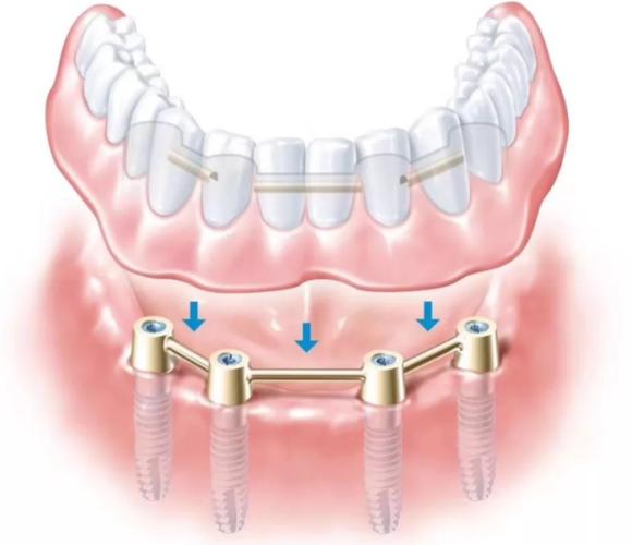 深圳哪里可以做种植牙？正规机构如何挑选？-图1