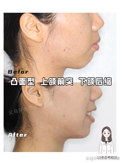 口腔正畸临床案例分享，哪些关键经验值得临床借鉴？-图3