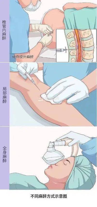 麻醉注射器方法-图2