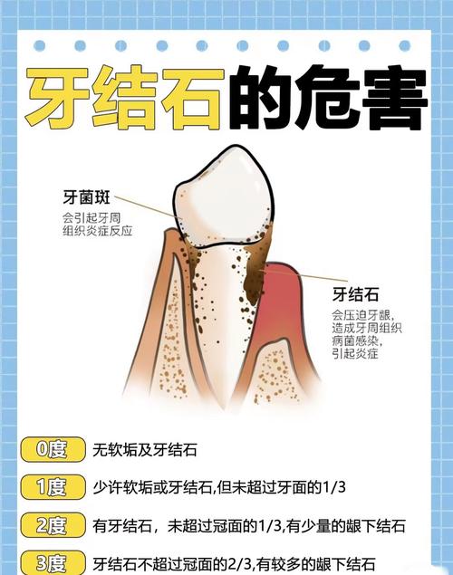 种牙前为何必须洗牙？洗牙的关键作用是什么？-图1