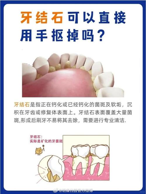 种牙前为何必须洗牙？洗牙的关键作用是什么？-图2