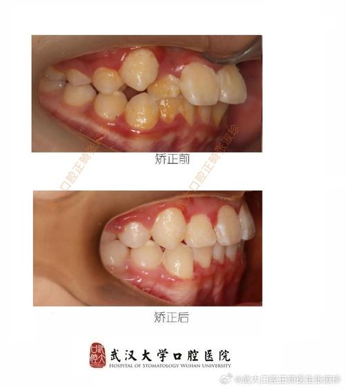 不做术前正畸是否可以-图2