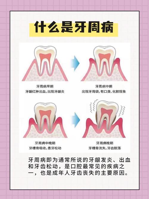 齿周病有哪些有效治疗方法？-图2