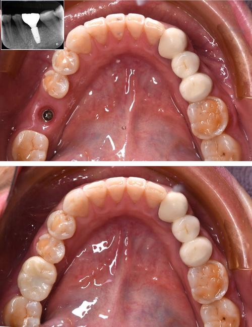 牙周炎未治直接种牙，可行吗？风险如何？-图1