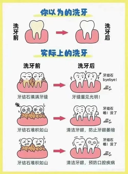 种牙期间能洗牙吗？医生提醒这几点要注意-图3