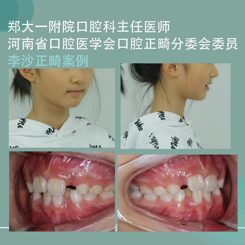 后牙咬合不齐，局部正畸能矫正好吗？怎么做？-图1