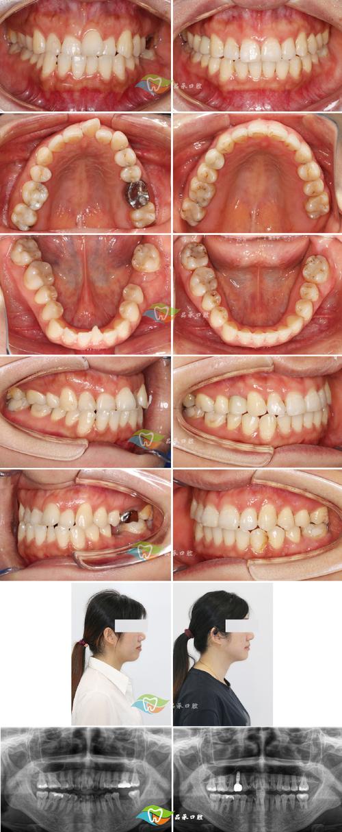 后牙咬合不齐，局部正畸能矫正好吗？怎么做？-图2