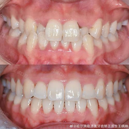 后牙咬合不齐，局部正畸能矫正好吗？怎么做？-图3