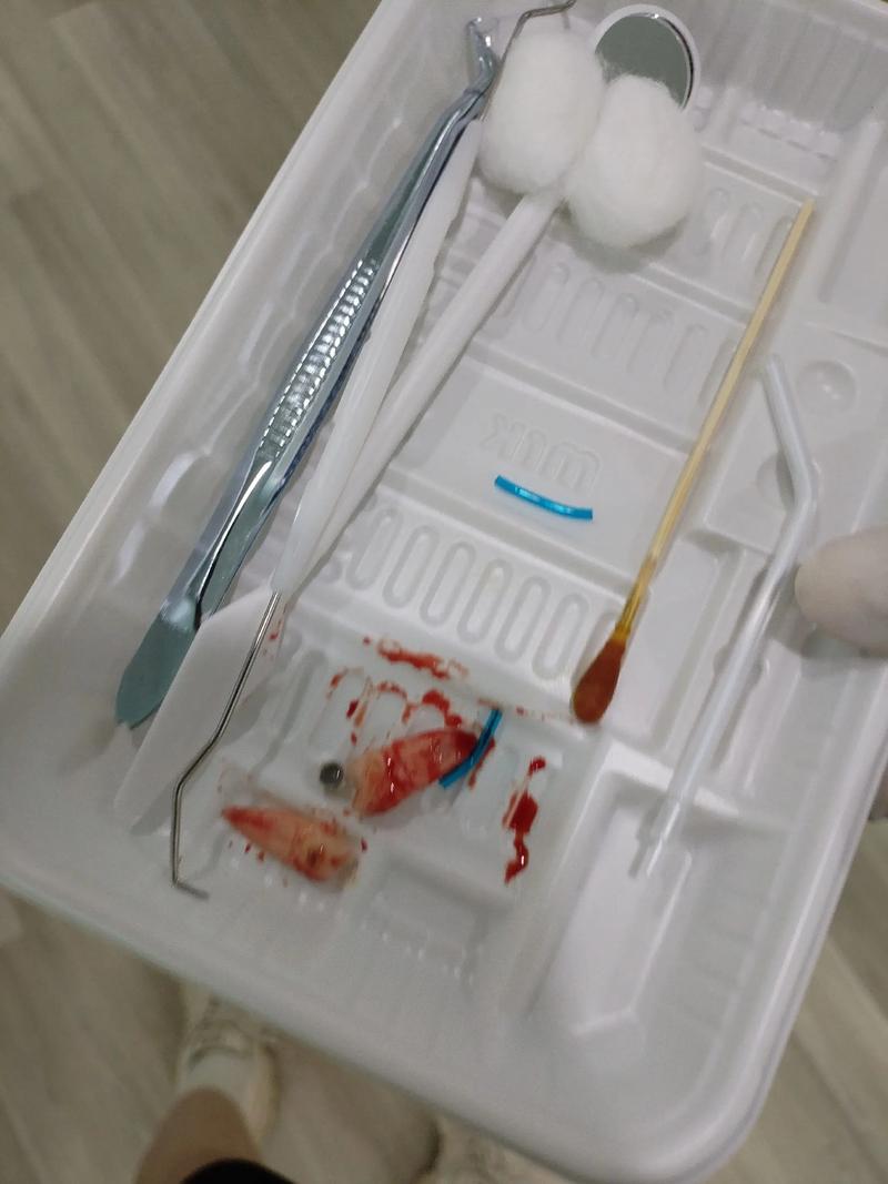 正畸拔牙麻药多久会消失？拔牙后多久能恢复感觉？-图1