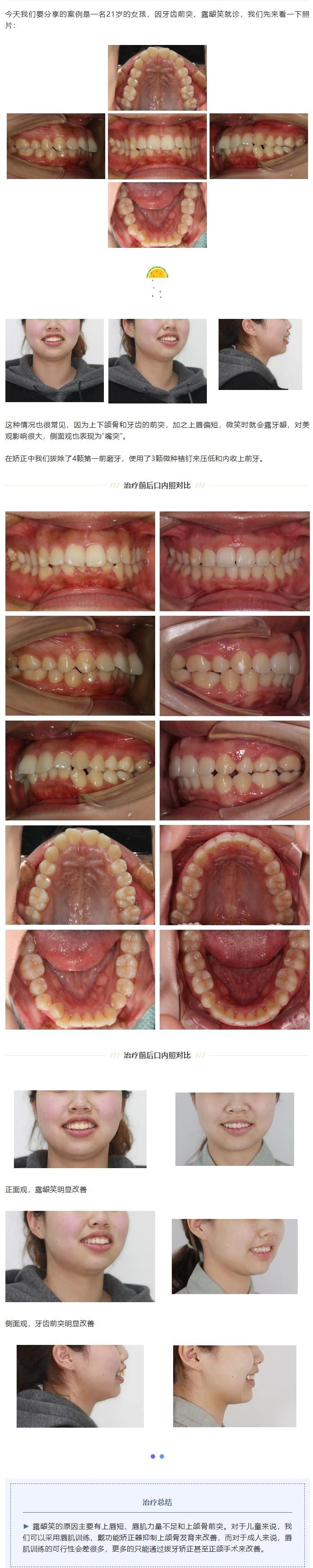 正畸过程出现牙根突出-图2