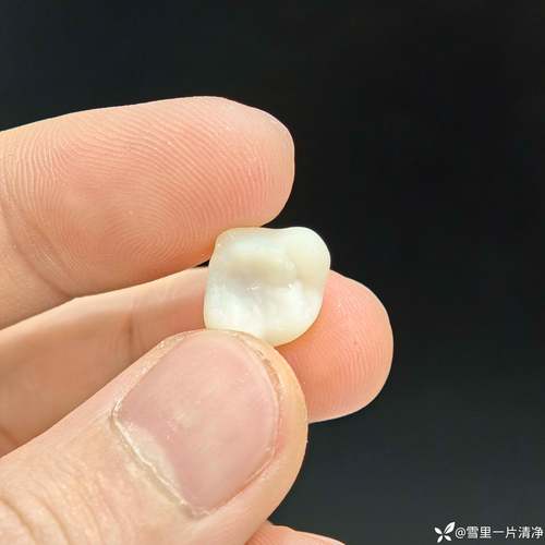 种牙后临时牙能用多久？日常护理要注意啥？-图1