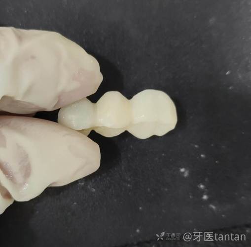 种牙后临时牙能用多久？日常护理要注意啥？-图2