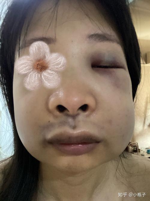 种牙为何要植入骨粉?牙脸会有影响吗?-图1 种牙为何要植入骨粉?牙脸会有影响吗?-图1