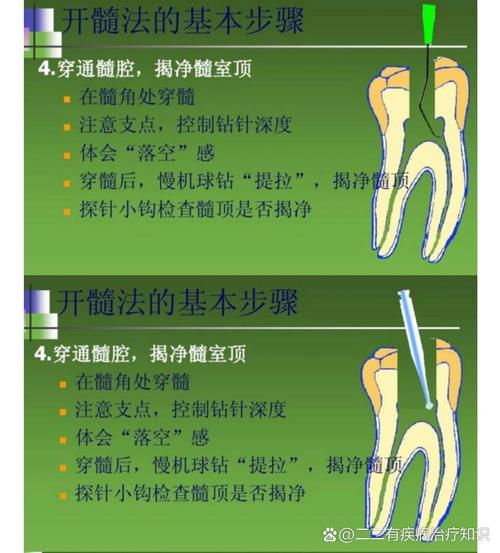 65管开牙的方法是什么？具体操作步骤有哪些？-图2