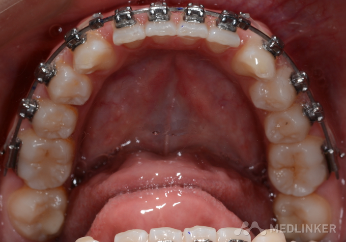 正畸钢丝滑动关闭间隙的操作步骤与技巧有哪些？-图1