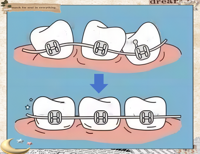 正畸钢丝滑动关闭间隙的操作步骤与技巧有哪些？-图2
